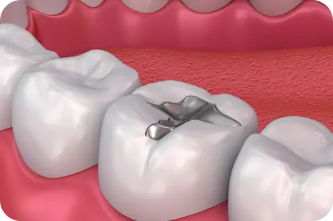 Tooth-colored fillings and restoration