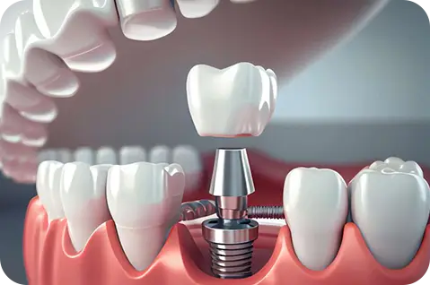 Dental implants procedure
