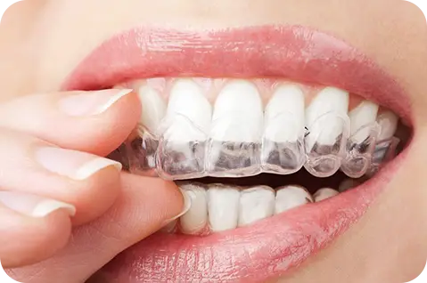 Invisalign clear aligners treatment