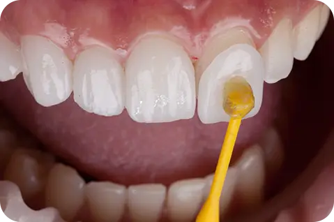 Porcelain veneers and smile makeover