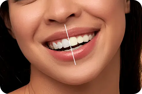 Professional teeth whitening